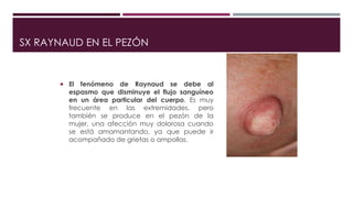 SX RAYNAUD EN EL PEZÓN
 El fenómeno de Raynaud se debe al
espasmo que disminuye el flujo sanguíneo
en un área particular del cuerpo. Es muy
frecuente en las extremidades, pero
también se produce en el pezón de la
mujer, una afección muy dolorosa cuando
se está amamantando, ya que puede ir
acompañado de grietas o ampollas.
 