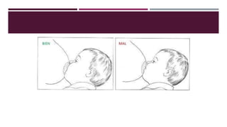 Alteraciones de las mamas en el puerperio