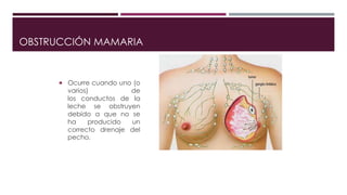 OBSTRUCCIÓN MAMARIA
 Ocurre cuando uno (o
varios) de
los conductos de la
leche se obstruyen
debido a que no se
ha producido un
correcto drenaje del
pecho.
 