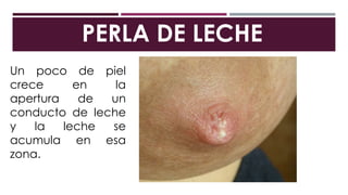PERLA DE LECHE
Un poco de piel
crece en la
apertura de un
conducto de leche
y la leche se
acumula en esa
zona.
 