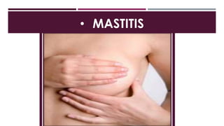 • MASTITIS
 