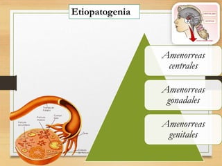 Etiopatogenia
Amenorreas
centrales
Amenorreas
gonadales
Amenorreas
genitales
 