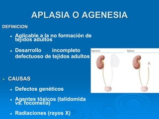 APLASIA O AGENESIA
DEFINICION
⚫ Aplicable a la no formación de
tejidos adultos
⚫ Desarrollo incompleto o
defectuoso de tejidos adultos
➢ CAUSAS
⚫ Defectos genéticos
⚫ Agentes tóxicos (talidomida
vs. focomelia)
⚫ Radiaciones (rayos X)
 