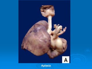 Aplasia
 