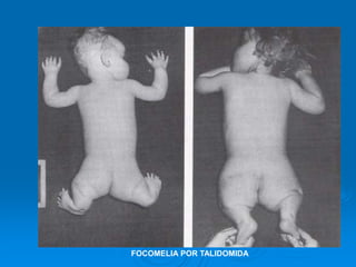 FOCOMELIA POR TALIDOMIDA
 