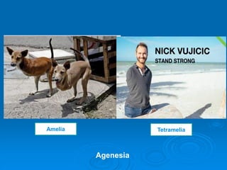 Tetramelia
Amelia
Agenesia
 