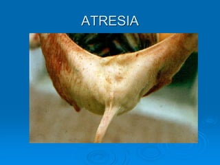 ATRESIA
 