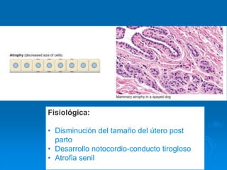 Fisiológica:
• Disminución del tamaño del útero post
parto
• Desarrollo notocordio-conducto tirogloso
• Atrofia senil
 