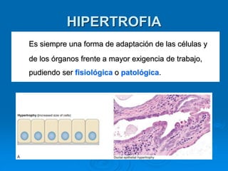 HIPERTROFIA
Es siempre una forma de adaptación de las células y
de los órganos frente a mayor exigencia de trabajo,
pudiendo ser fisiológica o patológica.
 