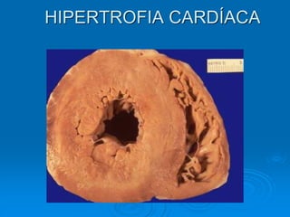 HIPERTROFIA CARDÍACA
 