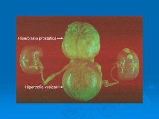 Hipertrofia vesical
Hiperplasia prostática
 