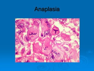 Anaplasia
 
