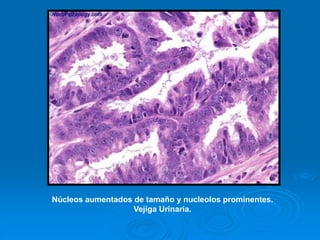 Núcleos aumentados de tamaño y nucleolos prominentes.
Vejiga Urinaria.
 
