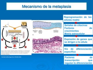 Mecanismo de la metaplasia
Reprogramación de las
células madre
Señales de citocinas
Factores de
crecimientos
Matriz extracelular
Expresión de genes que
se dirigen a la célula
Vía de diferenciación
especifica
Factores de
transcripción que
regulan la diferenciación
Rev Med Inst Mex Seguro Soc. 2018;56(1):46-52
 