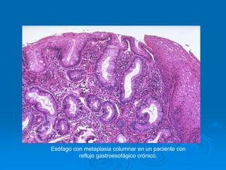 Esófago con metaplasia columnar en un paciente con
reflujo gastroesofágico crónico.
 