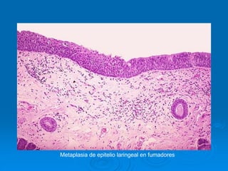 Metaplasia de epitelio laringeal en fumadores
 