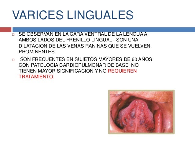 Alteraciones del desarrollo de la lengua