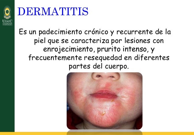 De la crema contra el hongo de las uñas