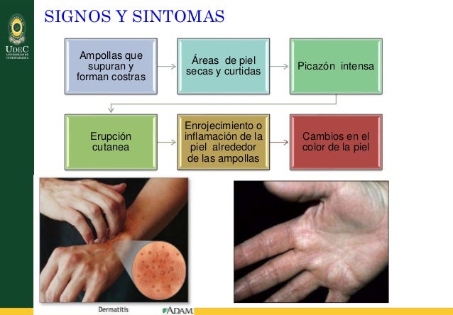 La psoriasis vertía por todo el cuerpo