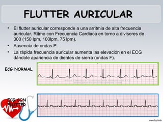 Alteraciones Del ECG PPT Alteraciones Del ECG PPT