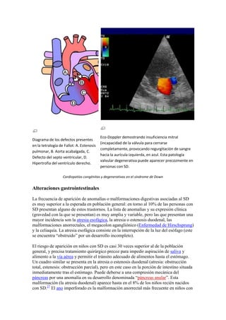 Eco-Doppler demostrando insuficiencia mitral
Diagrama de los defectos presentes
                                           (incapacidad de la válvula para cerrarse
en la tetralogía de Fallot: A. Estenosis
                                           completamente, provocando regurgitación de sangre
pulmonar, B. Aorta acabalgada, C.
                                           hacia la aurícula izquierda, en azul. Esta patología
Defecto del septo ventricular, D.
                                           valvular degenerativa puede aparecer precozmente en
Hipertrofia del ventrículo derecho.
                                           personas con SD.

                   Cardiopatías congénitas y degenerativas en el síndrome de Down


Alteraciones gastrointestinales

La frecuencia de aparición de anomalías o malformaciones digestivas asociadas al SD
es muy superior a la esperada en población general: en torno al 10% de las personas con
SD presentan alguno de estos trastornos. La lista de anomalías y su expresión clínica
(gravedad con la que se presentan) es muy amplia y variable, pero las que presentan una
mayor incidencia son la atresia esofágica, la atresia o estenosis duodenal, las
malformaciones anorrectales, el megacolon agangliónico (Enfermedad de Hirschsprung)
y la celiaquía. La atresia esofágica consiste en la interrupción de la luz del esófago (este
se encuentra “obstruido” por un desarrollo incompleto).

El riesgo de aparición en niños con SD es casi 30 veces superior al de la población
general, y precisa tratamiento quirúrgico precoz para impedir aspiración de saliva y
alimento a la vía aérea y permitir el tránsito adecuado de alimentos hasta el estómago.
Un cuadro similar se presenta en la atresia o estenosis duodenal (atresia: obstrucción
total, estenosis: obstrucción parcial), pero en este caso en la porción de intestino situada
inmediatamente tras el estómago. Puede deberse a una compresión mecánica del
páncreas por una anomalía en su desarrollo denominada “páncreas anular”. Esta
malformación (la atresia duodenal) aparece hasta en el 8% de los niños recién nacidos
con SD.27 El ano imperforado es la malformación anorrectal más frecuente en niños con
 