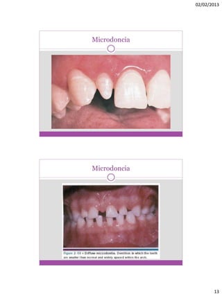 02/02/2013
13
Microdoncia
Microdoncia
 