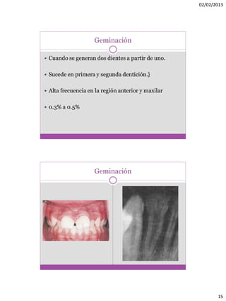 02/02/2013
15
Geminación
 Cuando se generan dos dientes a partir de uno.
 Sucede en primera y segunda dentición.}
 Alta frecuencia en la región anterior y maxilar
 0.3% a 0.5%
Geminación
 