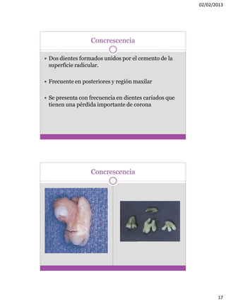 02/02/2013
17
Concrescencia
 Dos dientes formados unidos por el cemento de la
superficie radicular.
 Frecuente en posteriores y región maxilar
 Se presenta con frecuencia en dientes cariados que
tienen una pérdida importante de corona
Concrescencia
 