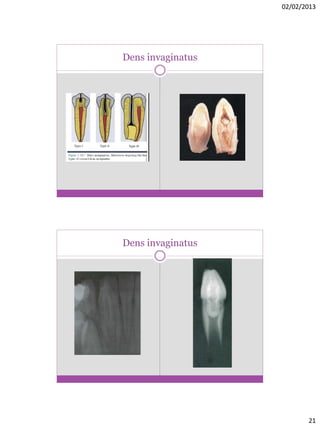 02/02/2013
21
Dens invaginatus
Dens invaginatus
 