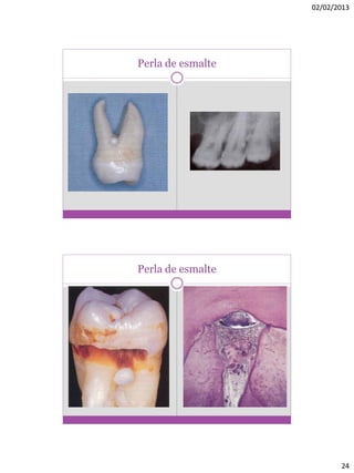 02/02/2013
24
Perla de esmalte
Perla de esmalte
 