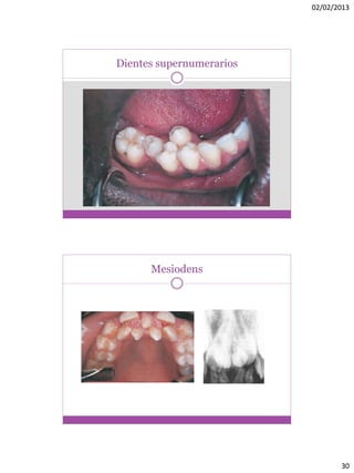 02/02/2013
30
Dientes supernumerarios
Mesiodens
 