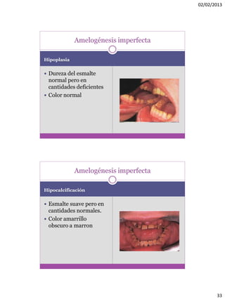 02/02/2013
33
Hipoplasia
 Dureza del esmalte
normal pero en
cantidades deficientes
 Color normal
Amelogénesis imperfecta
Hipocalcificación
 Esmalte suave pero en
cantidades normales.
 Color amarrillo
obscuro a marron
Amelogénesis imperfecta
 
