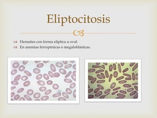 
 Hematies con forma elíptica u oval.
 En anemias ferropénicas o megaloblásticas.
Eliptocitosis
 