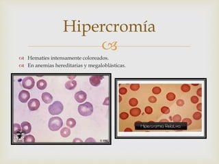 
 Hematíes intensamente coloreados.
 En anemias hereditarias y megaloblásticas.
Hipercromía
 