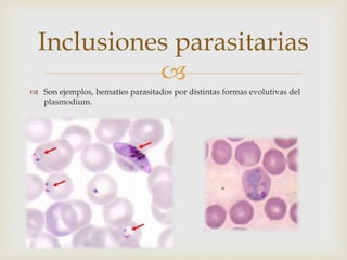 
 Son ejemplos, hematíes parasitados por distintas formas evolutivas del
plasmodium.
Inclusiones parasitarias
 