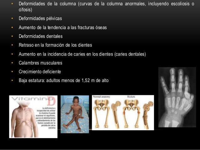 Alteraciones del sistema oseo