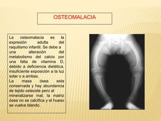 OSTEOMALACIA
La osteomalacia es la
expresión adulta del
raquitismo infantil. Se debe a
una alteración del
metabolismo del calcio por
una falta de vitamina D,
debido a deficiencia dietética,
insuficiente exposición a la luz
solar o a ambas.
La masa ósea esta
conservada y hay abundancia
de tejido osteoide pero al
mineralizarse mal, la matriz
ósea no se calcifica y el hueso
se vuelve blando.
 