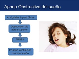 Apnea Obstructiva del sueño
Amígdalas hipertróficas
Obstrucción vía
aérea superior
Irrumpe ventilación
Irrumpe sueño
APNEA
 
