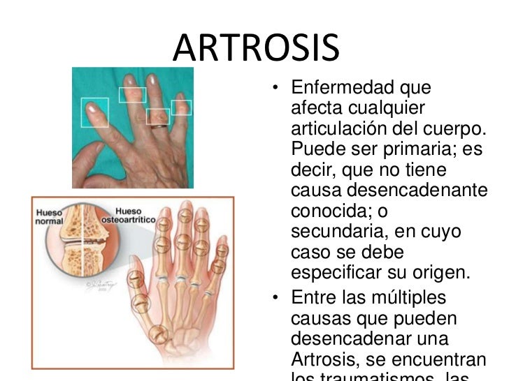 Alteraciones del tejido oseo relacionadas con el crecimiento