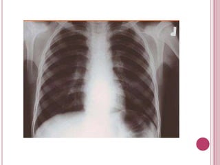 Alteraciones de tórax 