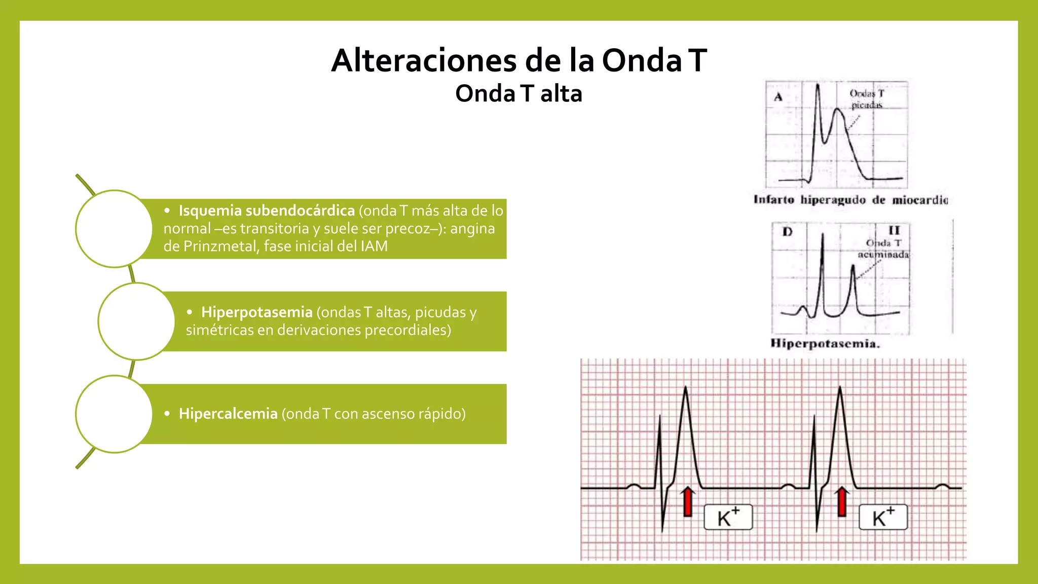 Alteraciones electrocardiográficas | PPT