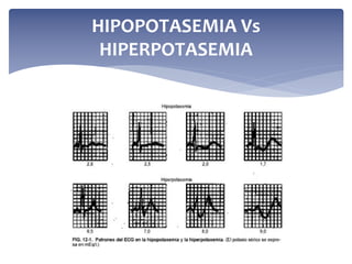 HIPOPOTASEMIA Vs
HIPERPOTASEMIA

 