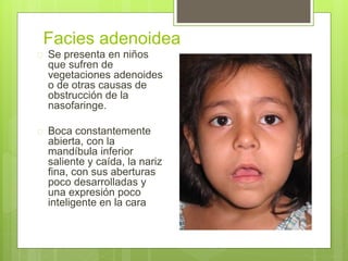 Facies adenoidea
 Se presenta en niños
que sufren de
vegetaciones adenoides
o de otras causas de
obstrucción de la
nasofaringe.
 Boca constantemente
abierta, con la
mandíbula inferior
saliente y caída, la nariz
fina, con sus aberturas
poco desarrolladas y
una expresión poco
inteligente en la cara
 