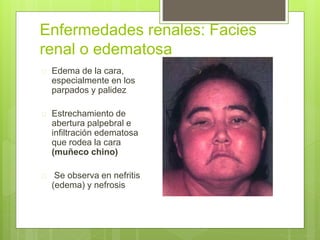 Enfermedades renales: Facies
renal o edematosa
 Edema de la cara,
especialmente en los
parpados y palidez
 Estrechamiento de
abertura palpebral e
infiltración edematosa
que rodea la cara
(muñeco chino)
 Se observa en nefritis
(edema) y nefrosis
 