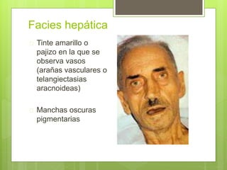 Facies hepática
 Tinte amarillo o
pajizo en la que se
observa vasos
(arañas vasculares o
telangiectasias
aracnoideas)
 Manchas oscuras
pigmentarias
 