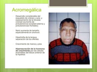 Acromegálica
 Desarrollo considerable del
esqueleto de cráneo y cara, y
espesamiento de la bóveda
craneal (aumento de
protuberancia occipital externa y
protuberancias frontales)
 Nariz aumenta de tamaño,
especialmente en anchura
 Hipertrofia de la lengua,
separación de los dientes
 Crecimiento de manos y pies
 Hipersecreción de la hormona
de crecimiento por las células
eosinófilas del lóbulo anterior de
la hipófisis
 