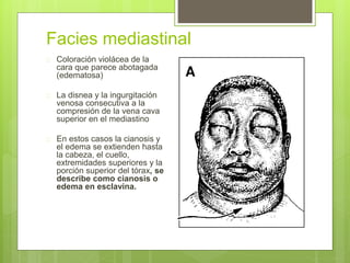 Facies mediastinal
 Coloración violácea de la
cara que parece abotagada
(edematosa)
 La disnea y la ingurgitación
venosa consecutiva a la
compresión de la vena cava
superior en el mediastino
 En estos casos la cianosis y
el edema se extienden hasta
la cabeza, el cuello,
extremidades superiores y la
porción superior del tórax, se
describe como cianosis o
edema en esclavina.
 