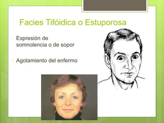 Facies Tifóidica o Estuporosa
 Expresión de
somnolencia o de sopor
 Agotamiento del enfermo
 