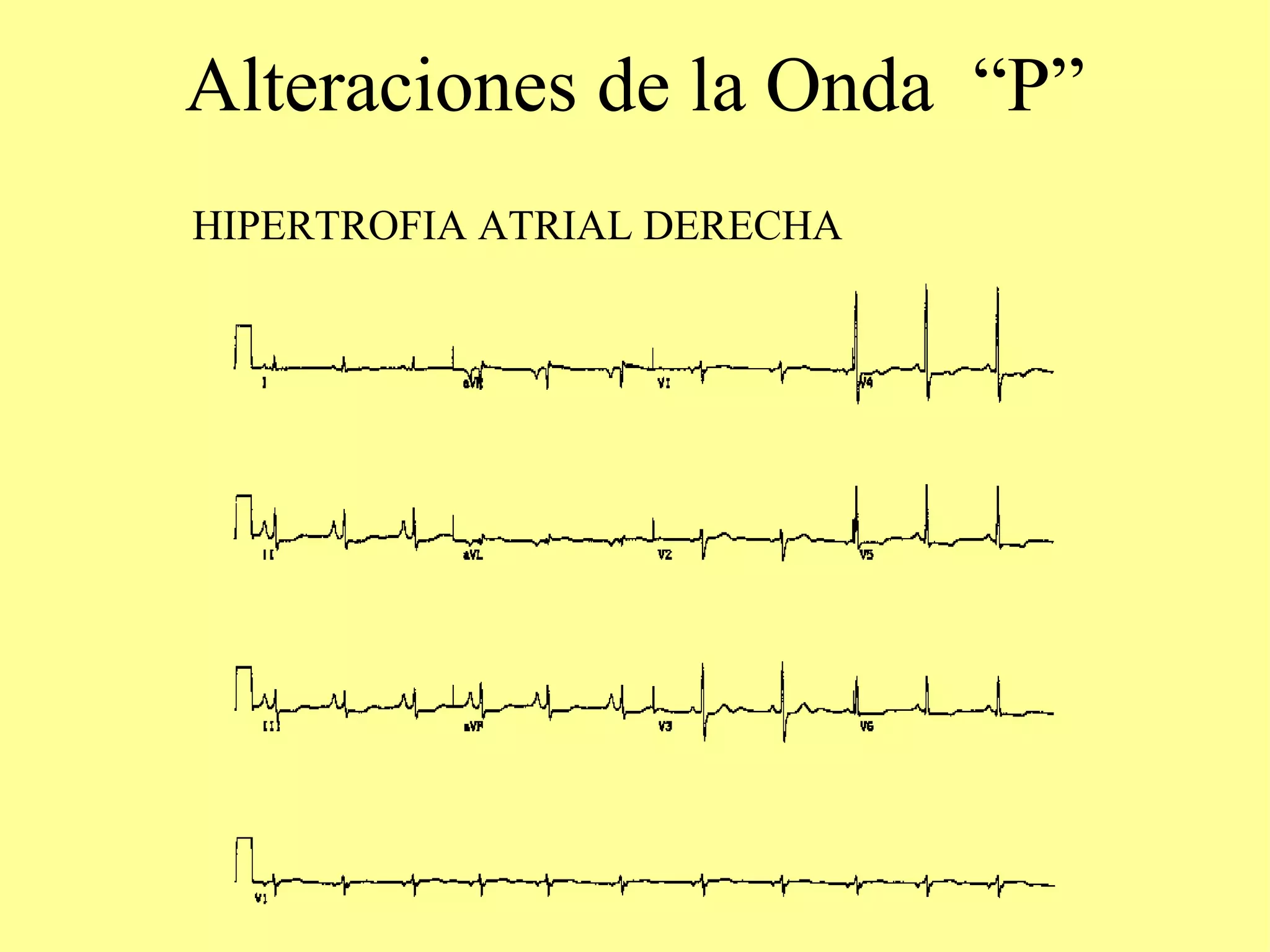 Alteraciones En Las Ondas Del Electrocardiograma | PPT