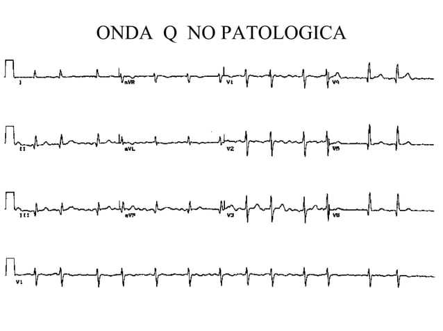 Alteraciones En Las Ondas Del Electrocardiograma | PPT